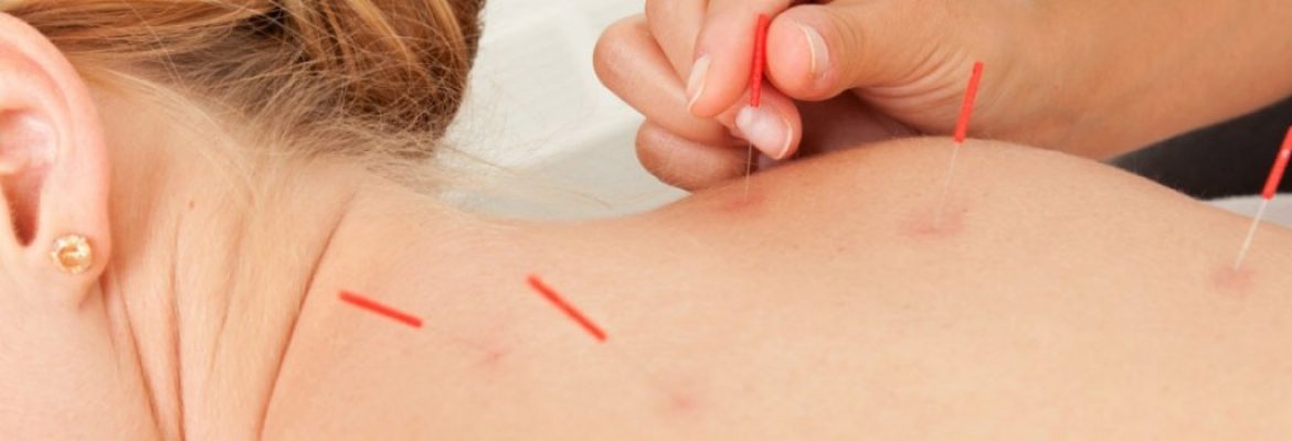 Acupuncture Lincoln |body balance acupuncture