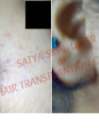 Satya Skin laser